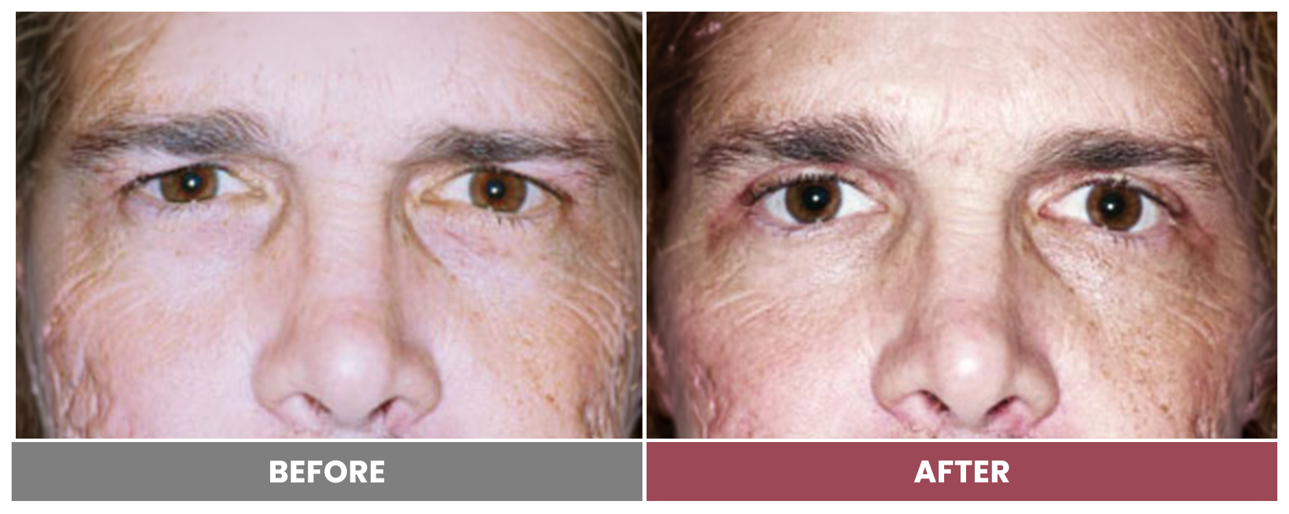 Upper Blepharoplasty - Case 98
